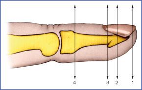 Fig. 9.7, Topography of Distal Amputations