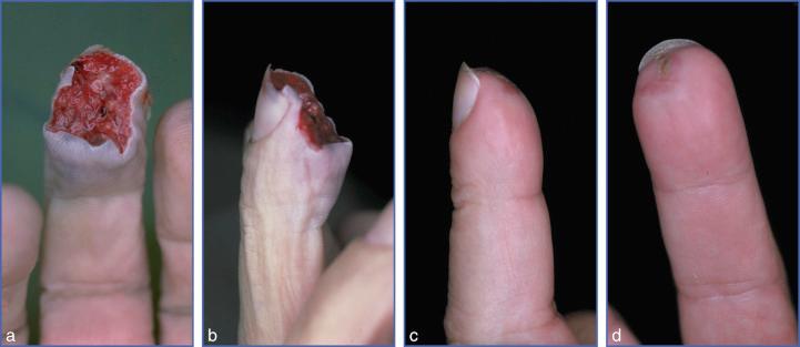 Fig. 9.8, Healing by Secondary Intention of Pulp Soft Tissue Defects.