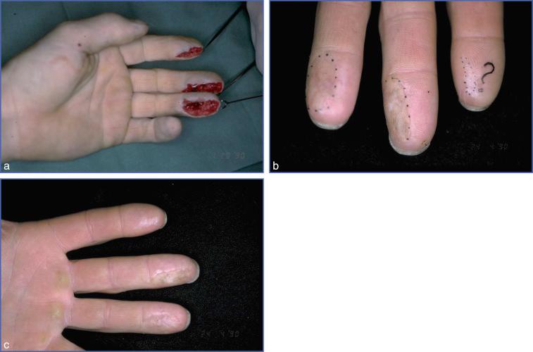 Fig. 9.9, Pulp Soft Tissue Defects: Full-Thickness Skin Graft.