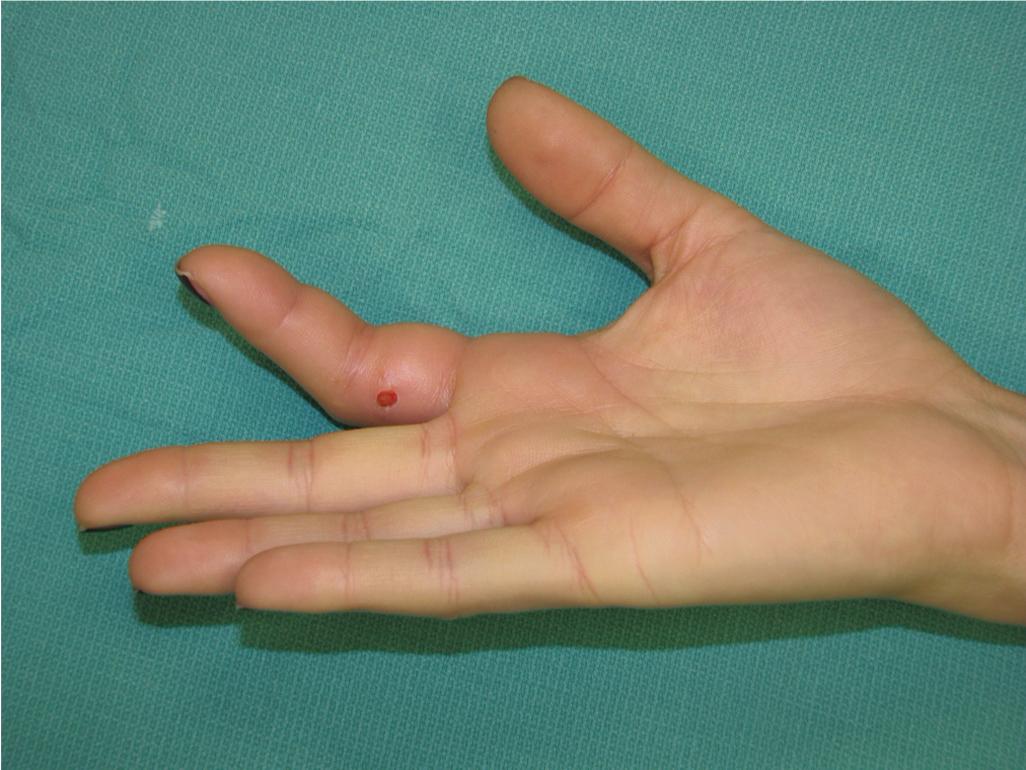 FIGURE 5.1, Flexor tenosynovitis, with the classic flexed posture and fusiform swelling of the affected index finger.