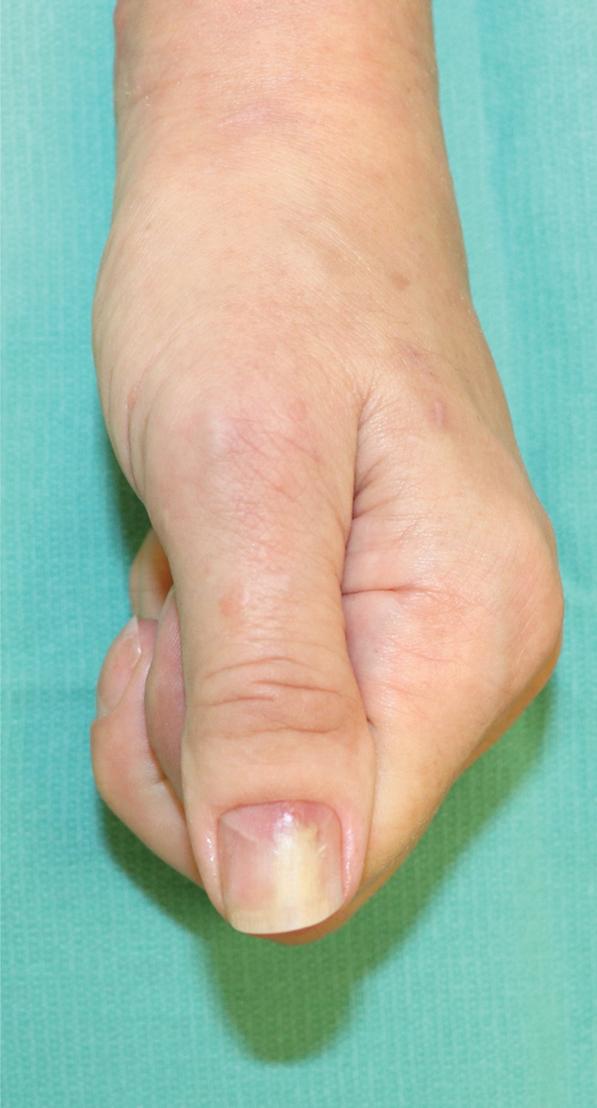 FIGURE 5.3, A patient with worsening thumb pain, proximal nail fold swelling, and obvious purulence beneath the nail.