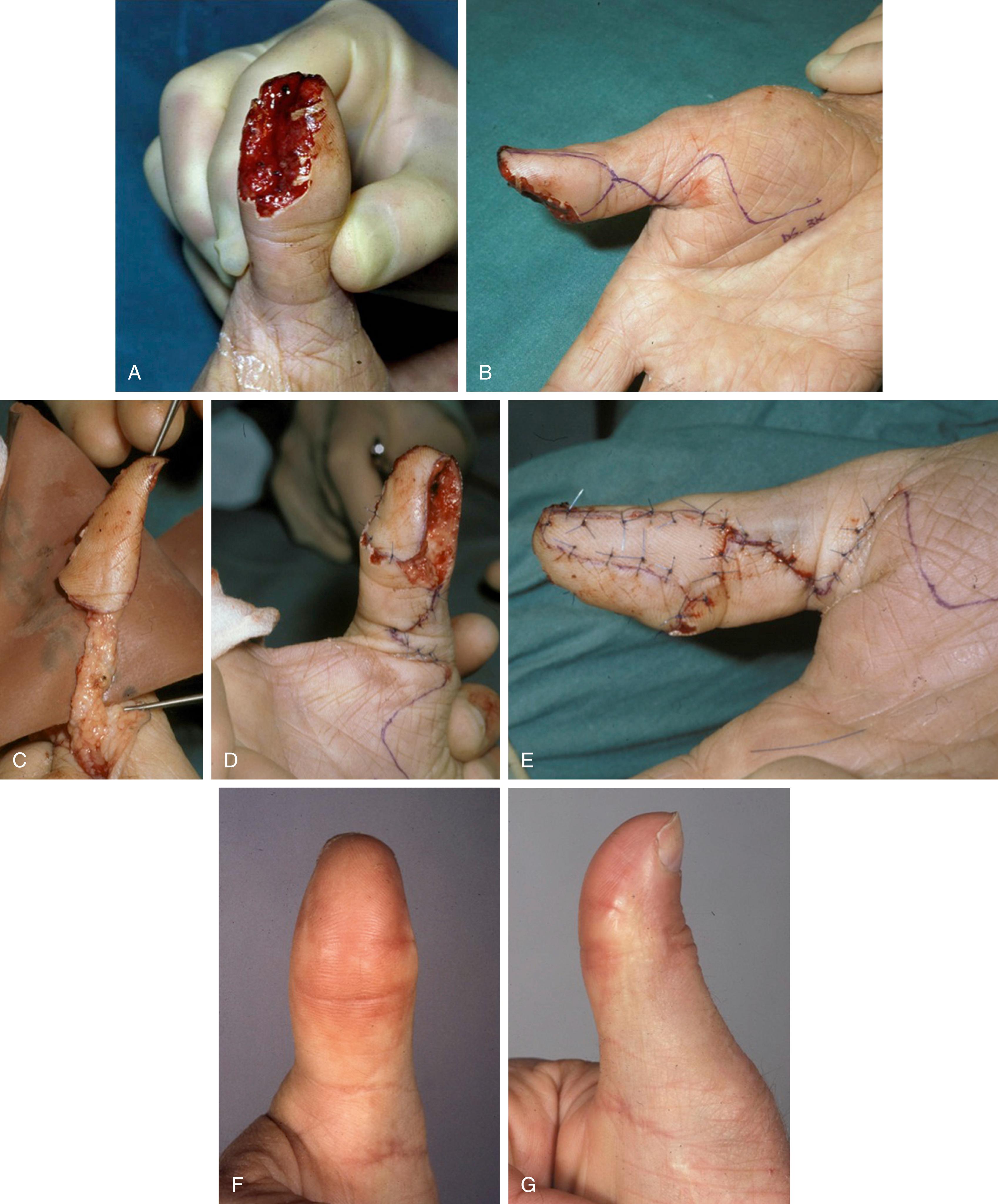 Fig. 46.2, Pulp exchange flap. (A) The defect involves the entire leading (ulnar)surface of the thumb pulp. (B) The trailing (radial) aspect of pulp is intact and an island flap is deigned on this pulp. (C) The flap is entirely islanded, leaving ample fat around the nerve and artery. (D) The island is transposed to reconstruct the ulnar pulp. (E) The secondary defect is resurfaced with a skin graft, in this case a full-thickness graft taken from the amputated part, which was de-fatted. (F,G) Final result at 3 months.