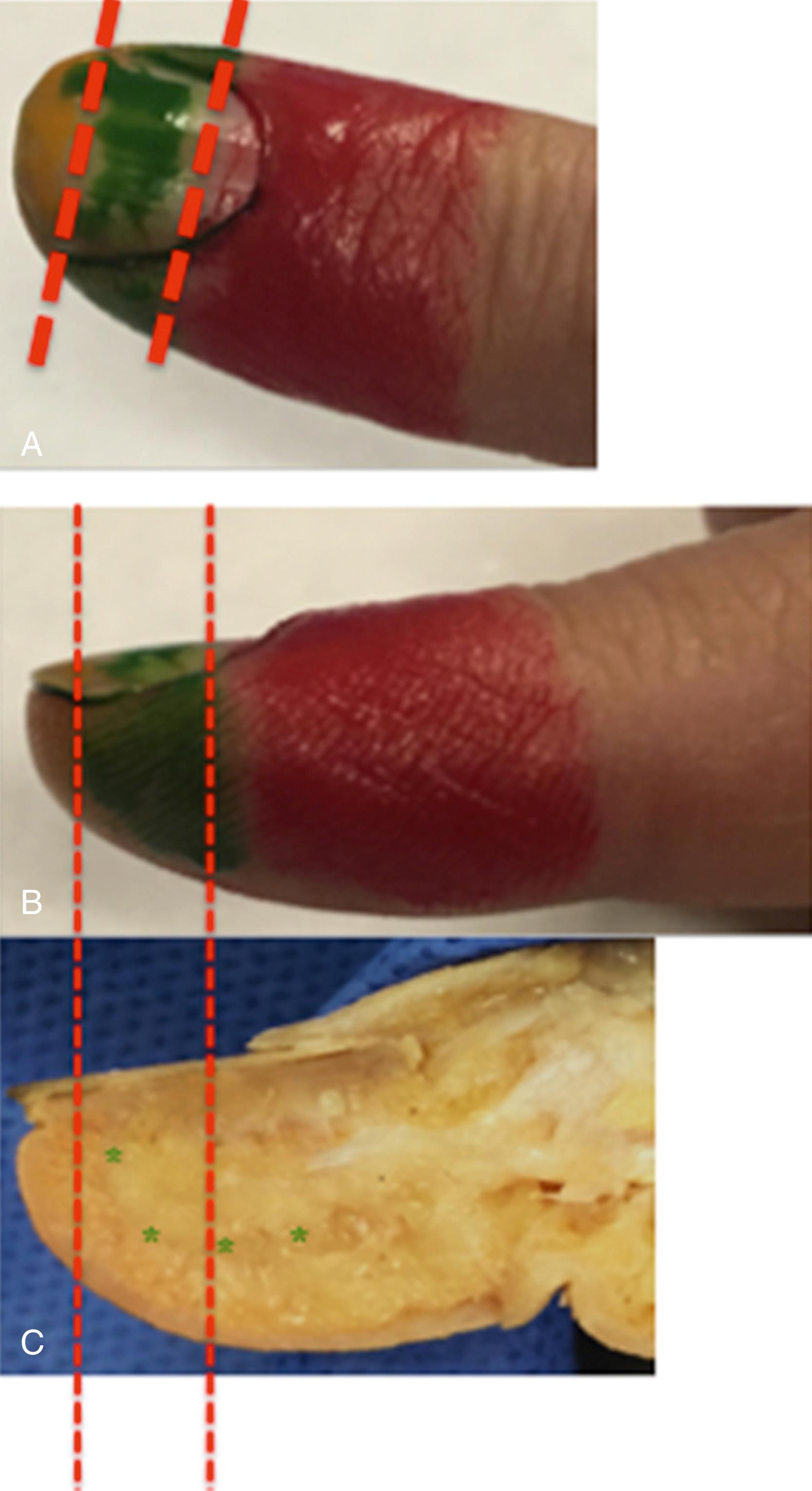 Fig. 46.3, The levels of amputation. Level 1 : There is a skin defect with minimal loss of nail and no significant loss of supporting distal phalanx. Indication: Dressing or, if bone exposed, advancement of skin flap. Level 2 : A significant portion of nail and supporting bone is lost. Indication: Ablation of nail remnant and trimming of bone so as to preserve the next vital structures, the insertion of extensor and flexor, while achieving tension free cover (direct closure or flap). Level 3 : The tendon insertions are disrupted. Indication: Trimming of bone and removal of articular cartilage to achieve skin cover with appropriate cover (direct closure or flap).