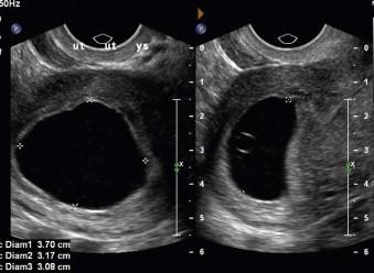FIGURE 1-1, A large gestation sac MSD >25 mm lacking an embryo which is consistent with early pregnancy failure.