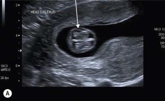 FIGURE 1-11, (A) Transverse scan through the head of an 11-week fetus showing choroid plexuses almost completely filling the fetal head. (B) Transverse scan through the head of a 13-week fetus showing a subtle change in the extent to which the cranium is filled by the choroid plexus.