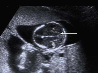 FIGURE 1-12, Transverse scan through the head of an 11-week fetus showing the cerebellum (arrow).