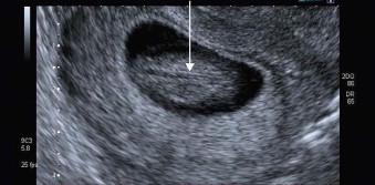 FIGURE 1-14, Coronal scan through the spine of a 10-week fetus showing parallel hypoechogenic lines (arrow).