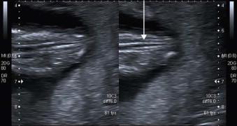 FIGURE 1-15, Coronal scan through the spine of a 12-week fetus showing normal ossification.