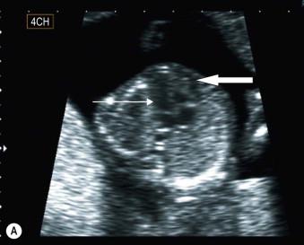 FIGURE 1-16, (A) Transverse scan through the thorax of a 12-week fetus showing the four-chamber view (block arrow – right ventricle, straight arrow – left ventricle). (B) Transverse scan through the thorax of a 12-week fetus showing the normal LVOT. (C) Transverse scan through the thorax of a 12-week fetus showing the normal RVOT. (D) First trimester diagnosis of an AVSD (lack of offset of the AV valves). (E) First trimester diagnosis of HLHS syndrome: echogenic immobile ventricular walls.