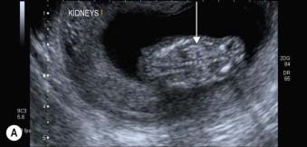 FIGURE 1-17, (A) Coronal scan of a 10-week fetus showing both kidneys (line arrow). (B) Coronal scan of a 13-week fetus showing both kidneys (line arrow).