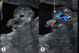 FIGURE 1-18, (A) Transverse scan through the pelvis of a 12-week fetus showing bladder – straight arrow. (B) Colour flow image of same fetus showing both umbilical arteries surrounding the bladder.