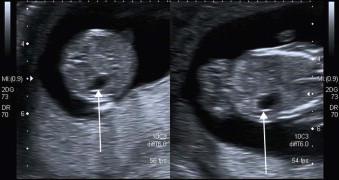 FIGURE 1-20, Transverse scan through the abdomen of a 12-week fetus showing the stomach – arrows.