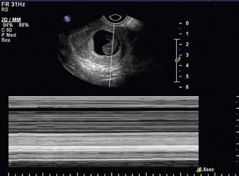 FIGURE 1-2, An embryo of CRL over 7 mm without cardiac activity is consistent with early pregnancy failure.