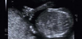 FIGURE 1-21, Fetal fingers at 12 weeks' gestation.