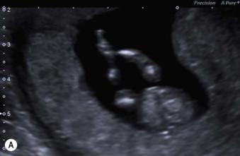 FIGURE 1-22, (A) Fetal legs. (B) Fetal foot at 12 weeks' gestation.