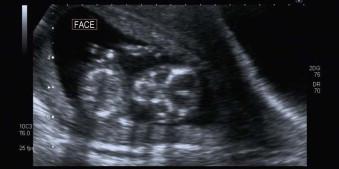 FIGURE 1-23, Coronal scan through 12-week fetus showing orbits, maxilla and mandible.