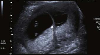FIGURE 1-3, The lambda sign of a dichorionic twin gestation: placental tissue protruding into the intertwin membranes (arrow).