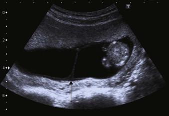 FIGURE 1-4, The T sign/negative lambda sign of a monochorionic twin gestation.