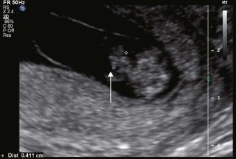 FIGURE 1-5, Physiological exomphalos (echogenic bowel-only mass which is always <7 mm in transverse section).