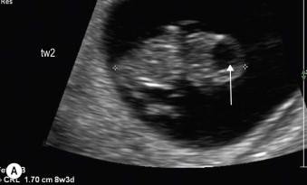 FIGURE 1-6, (A) The normal rhombencephalon. (B) A fetus with holoprosencephaly.