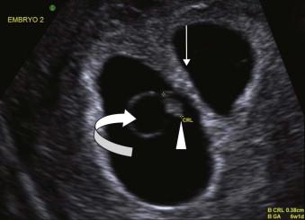 FIGURE 1-7, Transvaginal scan of a 6-week pregnancy showing the embryo (arrowhead), yolk sac (curved arrow) and amniotic sac (arrow).