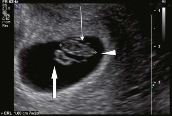 FIGURE 1-9, Transvaginal scan of a 7-week pregnancy showing the embryo (arrow head), amniotic sac (line arrow) and the yolk sac (block arrow) lying outside the amniotic sac within the extraembryonic coelom.