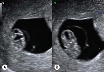 FIGURE 1-10, Coronal scan through the cephalic pole of an 8-week embryo showing the rhombencephalon (A) and the prosencephalon (B).