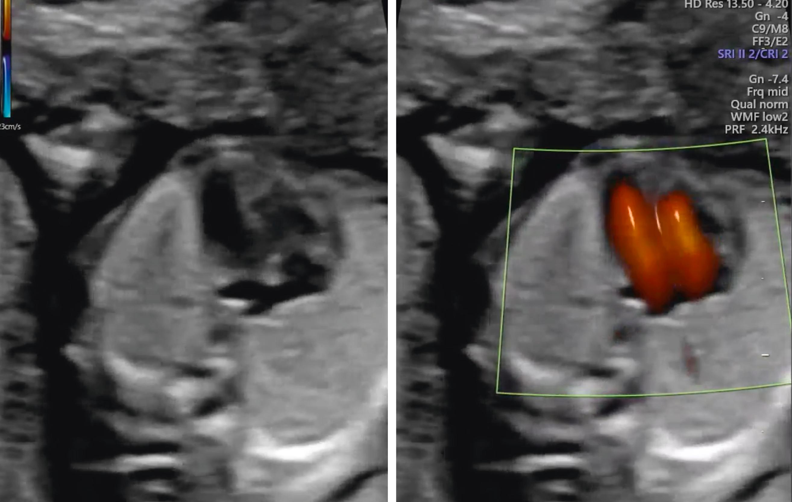 Figure 29.11, Four-chamber heart.