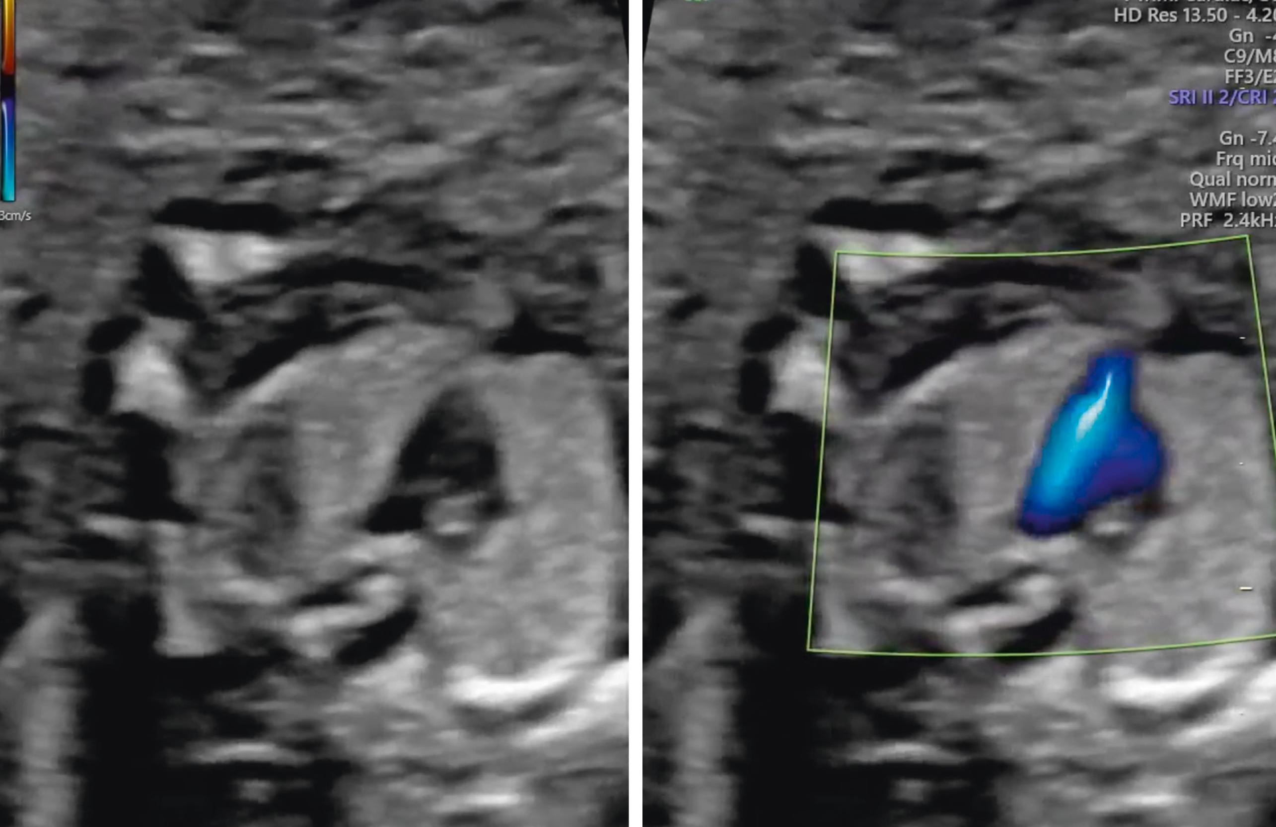 Figure 29.12, Three-vessel trachea view.