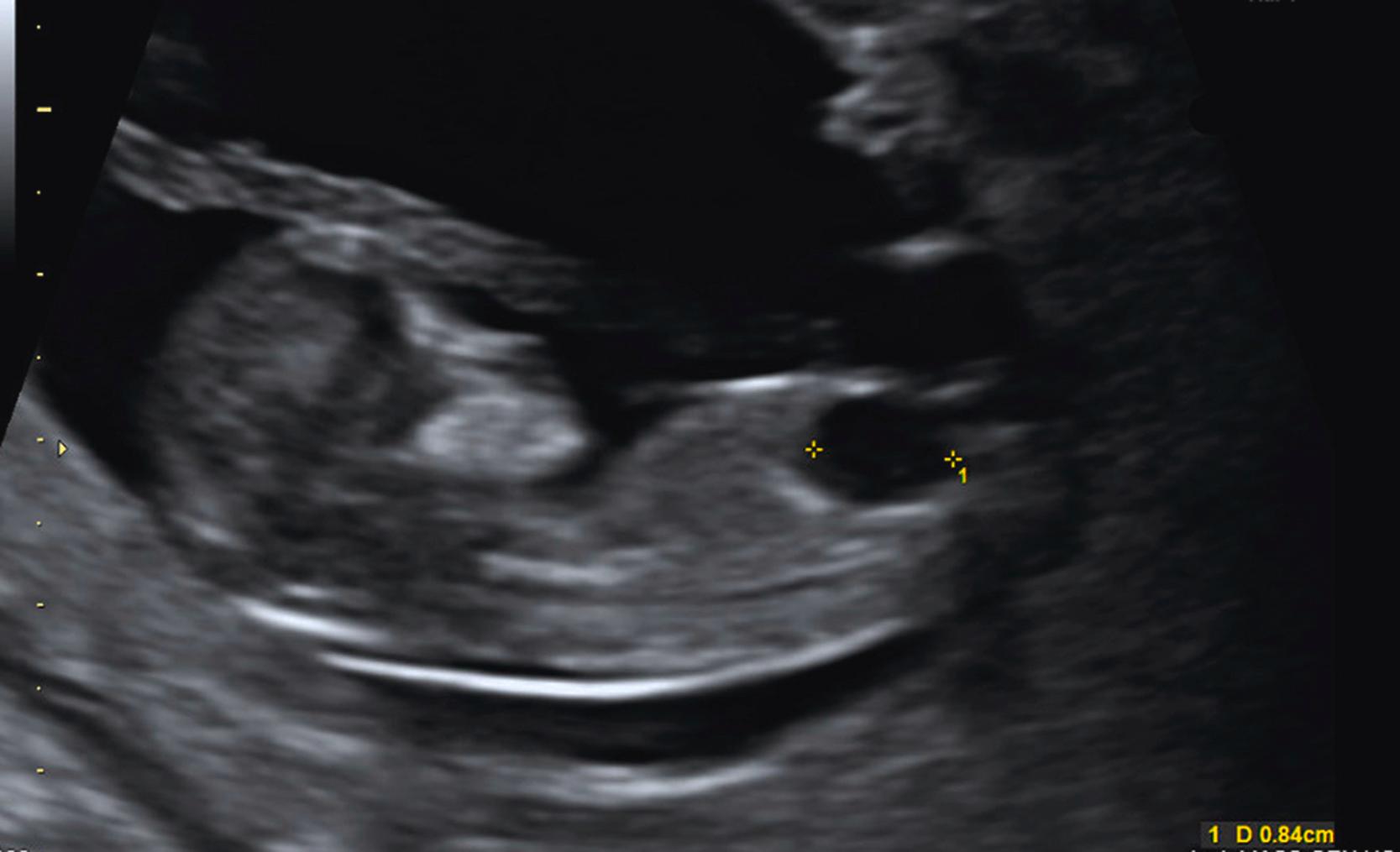 Figure 29.15, Sagittal scan of a 12-week fetus demonstrating megacystis with a bladder length of 8 mm.