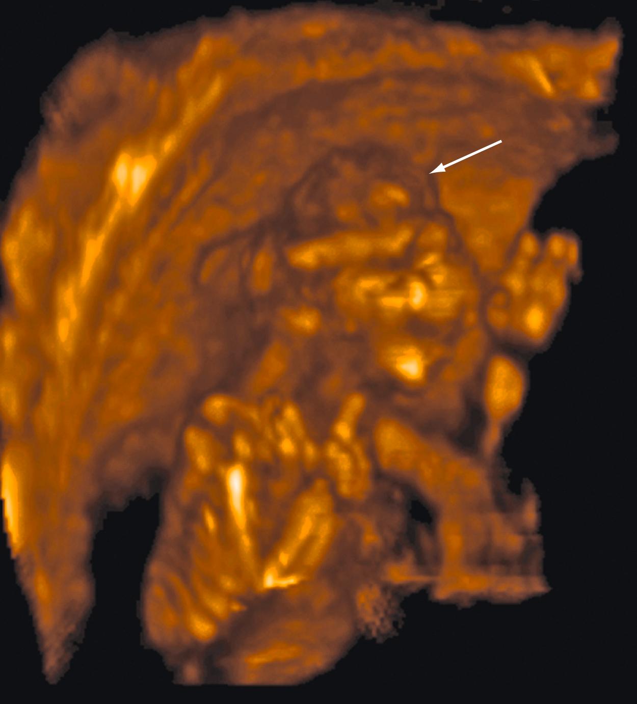 Figure 29.2, Anencephaly.