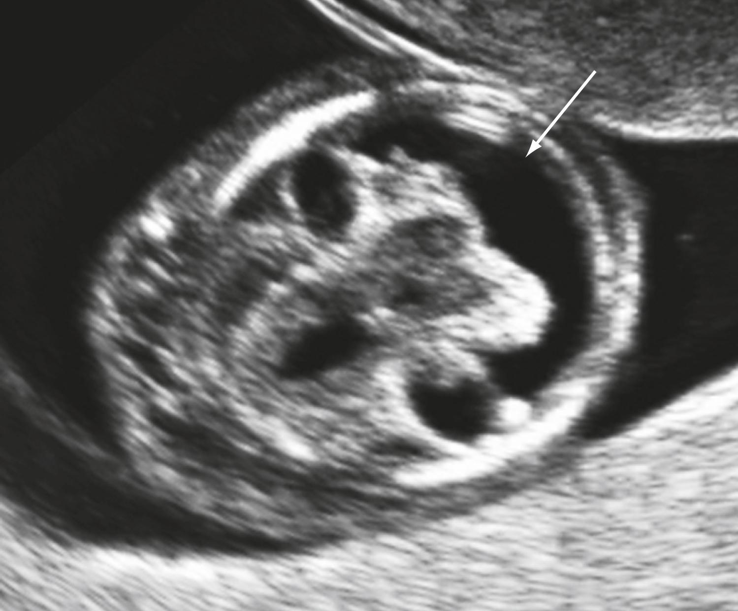 Figure 29.3, Alobar holoprosencephaly.