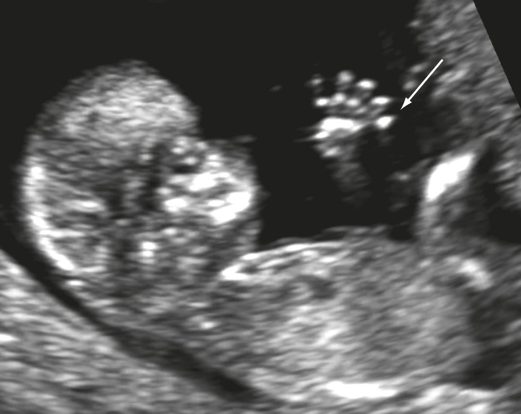 Figure 29.6, Postaxial polydactyly.