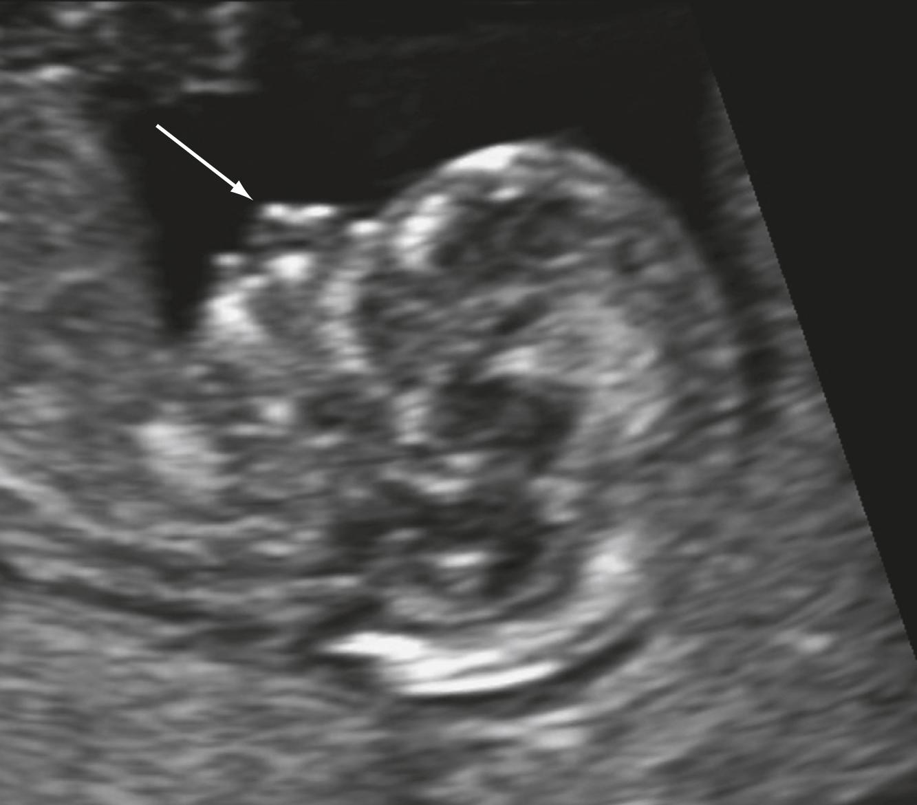 Figure 29.8, Cleft lip.