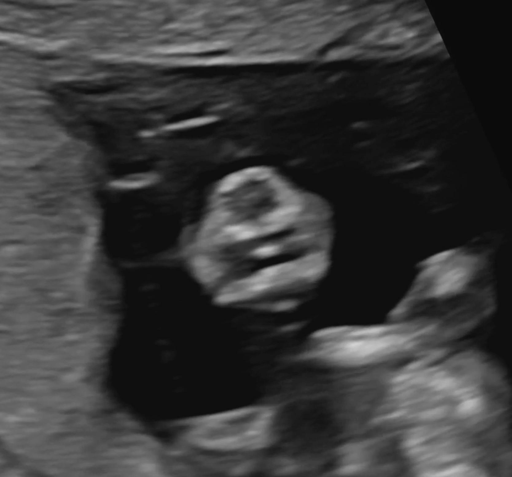 Figure 29.10, Retronasal triangle view of a fetus at 13 weeks demonstrating absence of the mandibular gap.