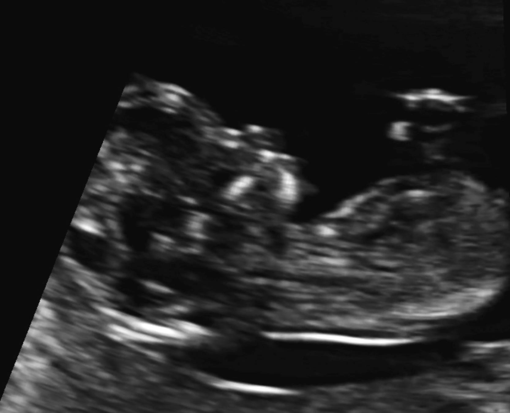 Figure 29.9, Sagittal scan through a 12-week fetus with a facial cleft, demonstrating a maxillary gap.