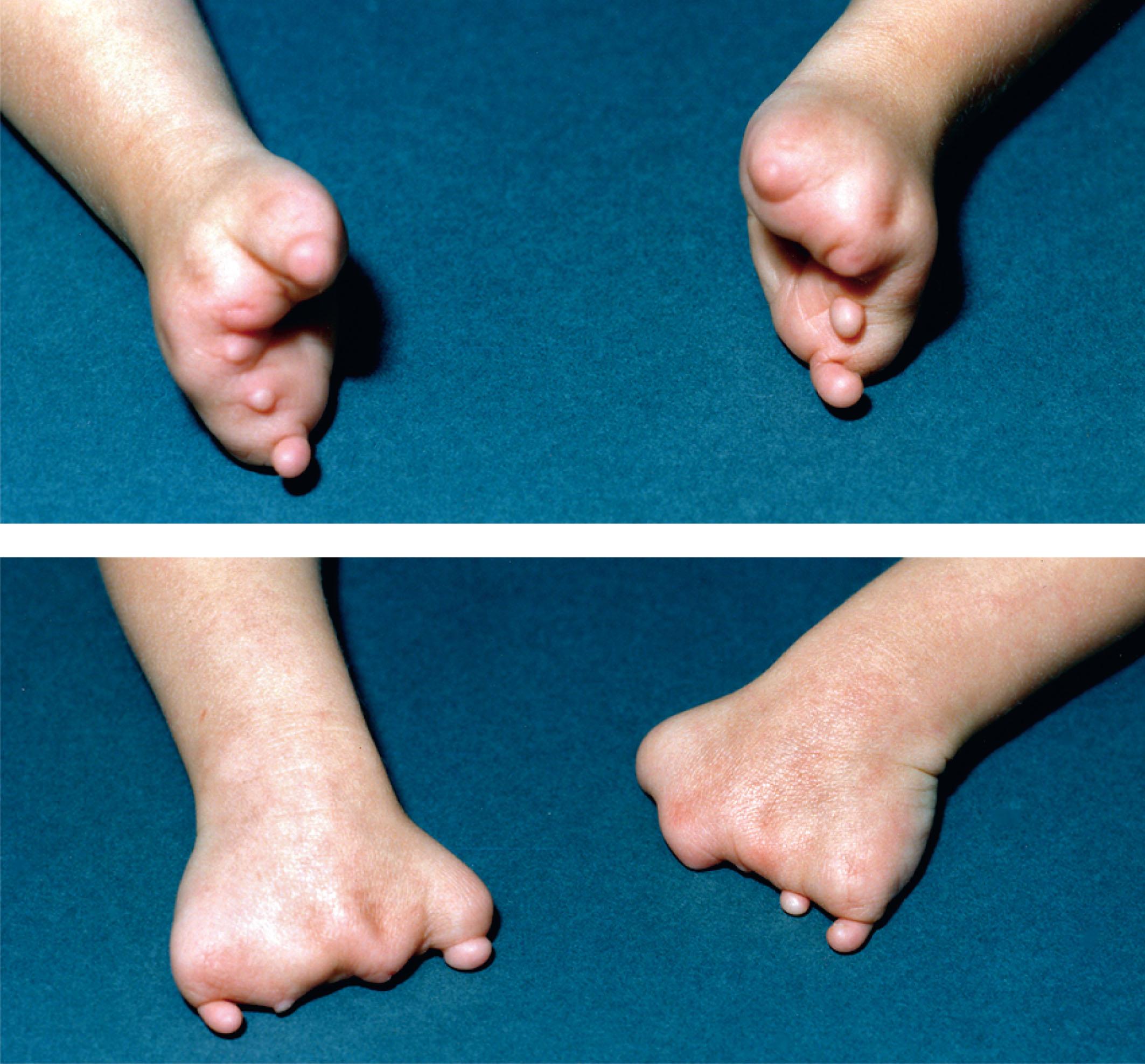 FIGURE 50.1, Disruptive loss of fingers in the hand (affecting central digits more severely). The mother of this fetus underwent chorionic villus sampling at 7–8 weeks and, in addition to these digital-reduction defects, there was a flank hemangioma.