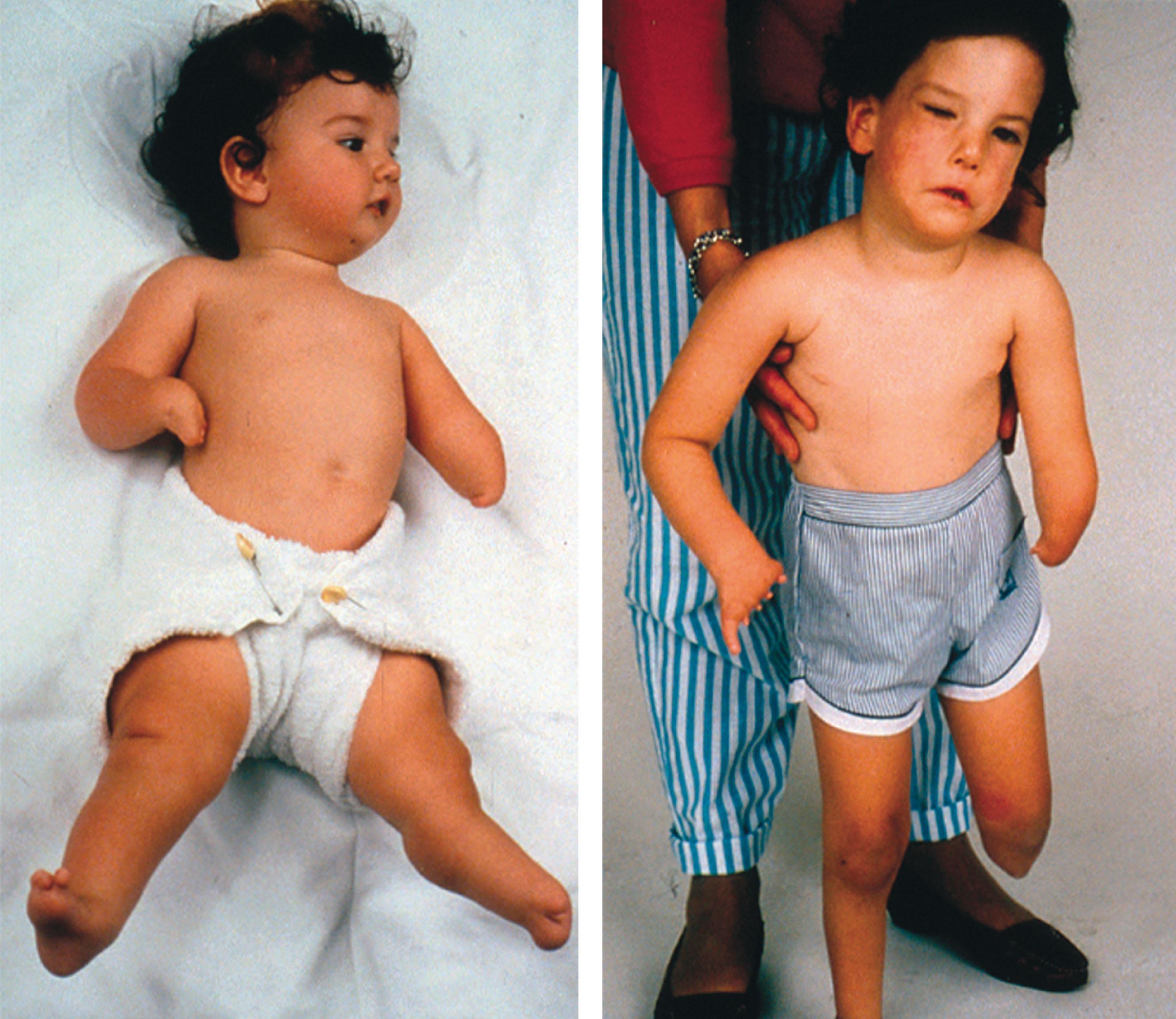 FIGURE 50.2, These children were born following prolonged high fever at 7 weeks’ gestation with terminal transverse limb-reduction defects, ankyloglossia, missing teeth, and bilateral sixth and seventh cranial nerve palsies. This same pattern of defects has been induced experimentally in animals following exposure to heat at an equivalent stage of gestation.