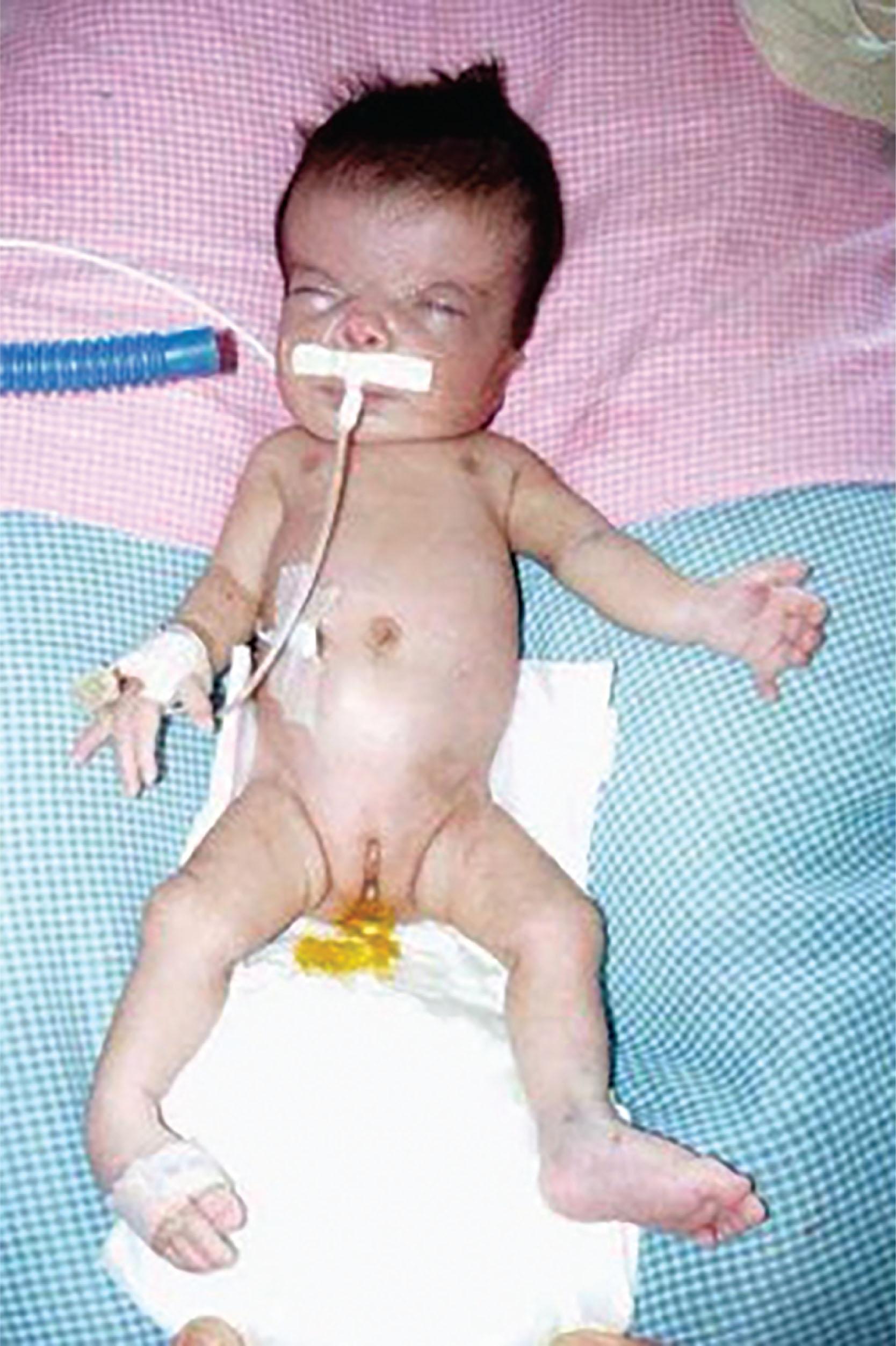 FIGURE 50.3, This newborn was born with methotrexate embryopathy after exposure to low-dose weekly methotrexate (7.5 mg) during the first trimester of pregnancy. They were born with intrauterine growth restriction at 31 weeks with microcephaly, wide anterior fontanel, high forehead, low nasal bridge, ocular proptosis, dysplastic low-set ears, high arched palate, short neck, narrow chest, abnormal fifth fingers, and right clubfoot. Brain ultrasound showed moderate dilatation of the lateral ventricles. Radiographs of the hands showed absence of the fifth metacarpal bone and phalanges bilaterally.