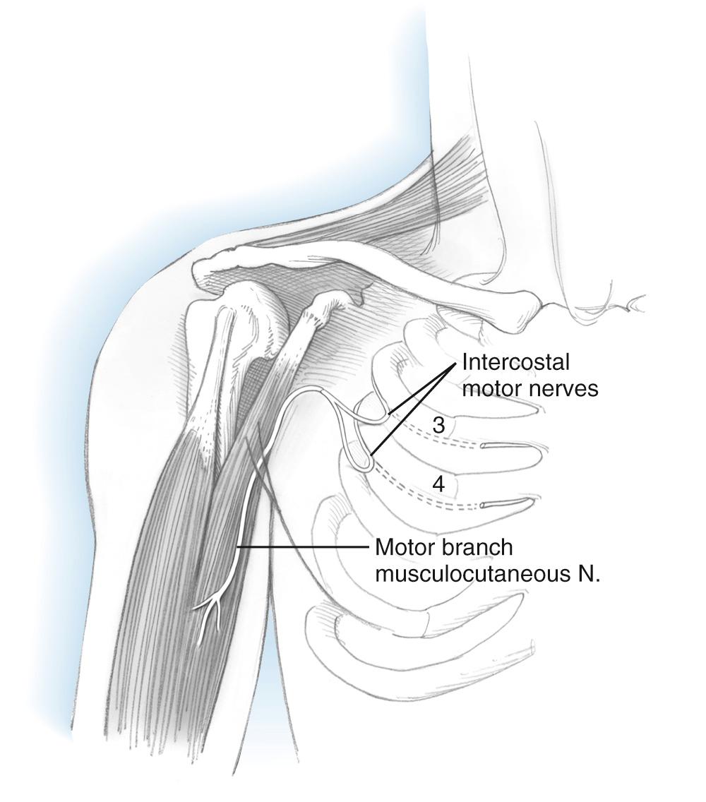 FIG 117.1, Intercostal nerve neurotization of the musculocutaneous nerve.