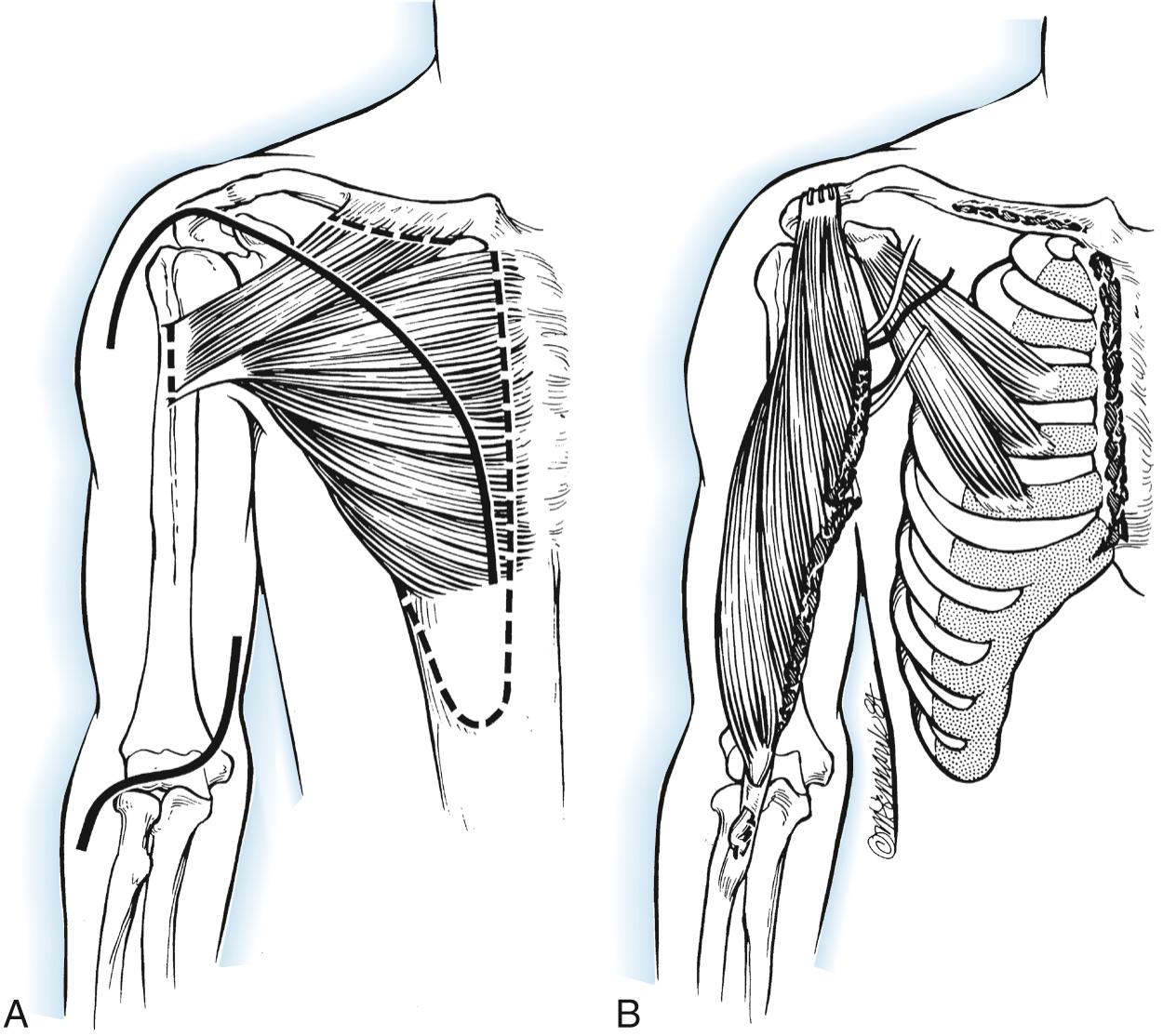 FIG 117.12, Bipolar transplantation of the pectoralis major muscle for elbow flexion. (A) The incisions. Solid lines indicate skin incisions, and dotted lines indicate the extent of detachment of the pectoralis major and rectus abdominis sheath. (B) The completely detached pectoralis major is rotated on its two neurovascular pedicles. Its origin is attached to the biceps tendon, and its insertion is attached to the acromion through drill holes.