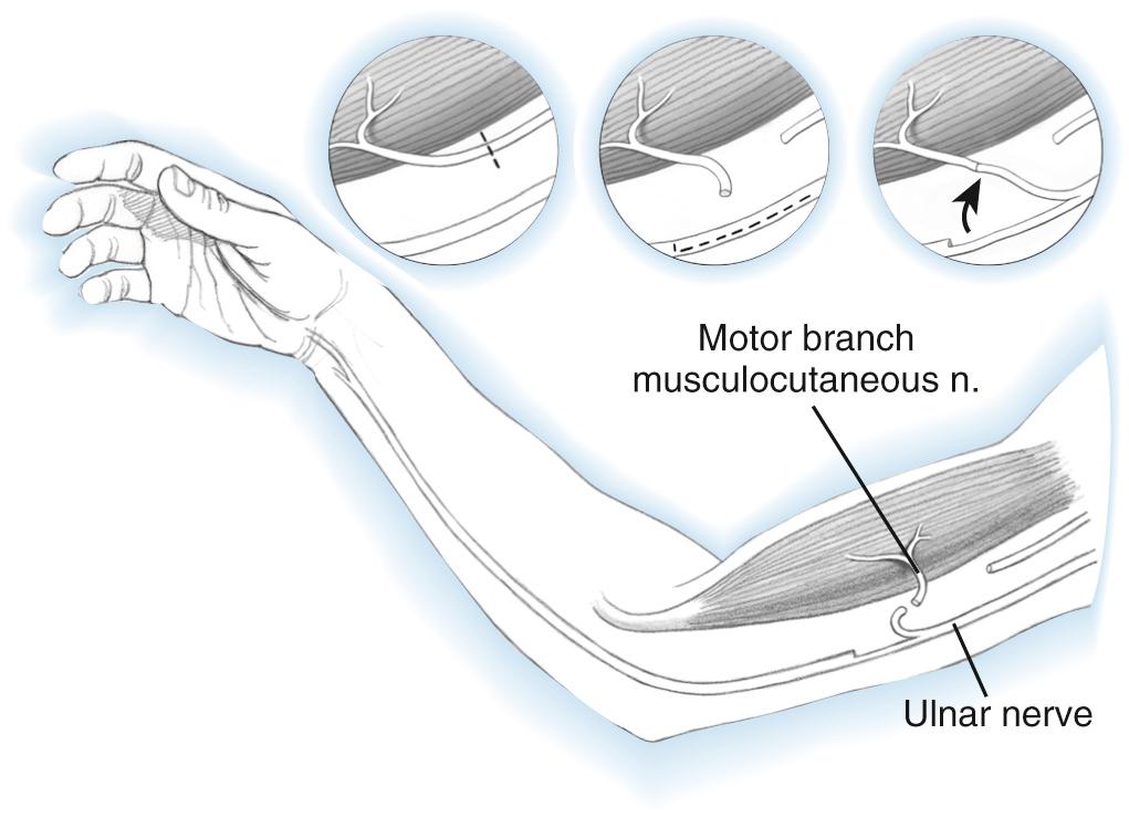 FIG 117.2, Oberlin 117 transfer of the ulnar nerve to the musculocutaneous nerve. When the ulnar nerve is intact, a fascicle can be transferred to the biceps motor branch to restore elbow flexion.