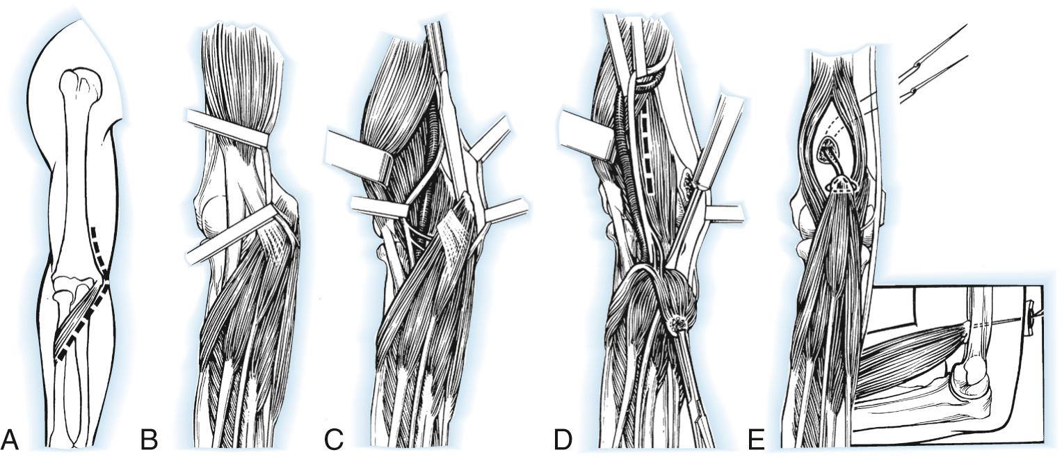 FIG 117.3, Steindler's flexorplasty. 135 (A) The incision. (B) The ulnar nerve is mobilized proximally and distally, and its motor branches to the flexor carpi ulnaris are identified and protected. (C) The common flexor-pronator origin is detached with a flake of medial epicondyle. The motor branches of the median nerve to the flexor-pronator group are identified and protected. (D) The detached flexor-pronator group is mobilized distally as far as the motor branches of the medial and ulnar nerves will permit. The brachialis muscle is divided. (E) The distal humerus is prepared, and a prolene pull-out suture is used to anchor the transferred muscles to the anterolateral surface of the humerus 5 to 7.5 cm above the elbow.