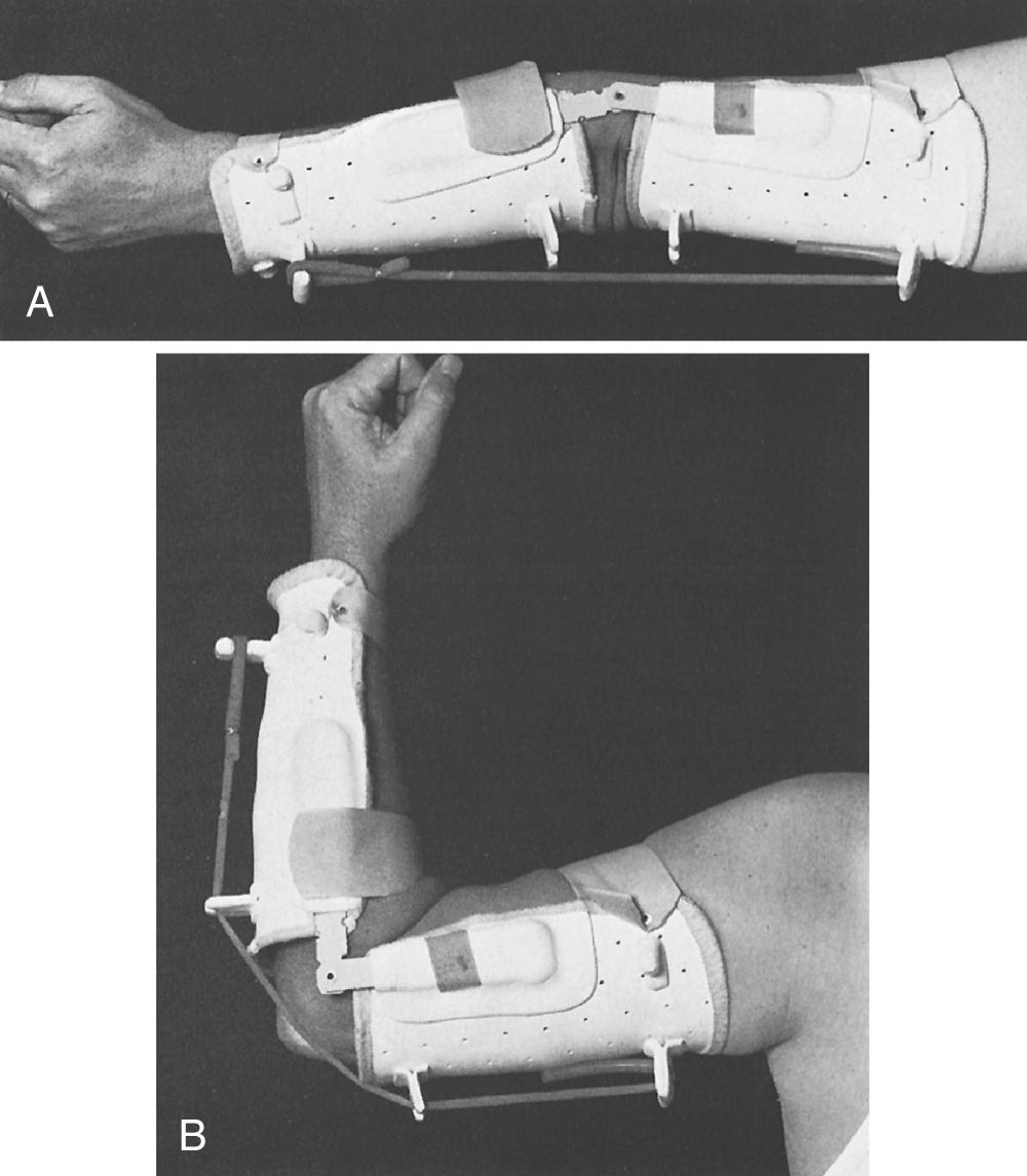 FIG 117.4, (A,B) A dynamic flexion and extension elbow splint. The dynamic extension is particularly useful in patients who have Steindler's flexorplasty but lack triceps function.