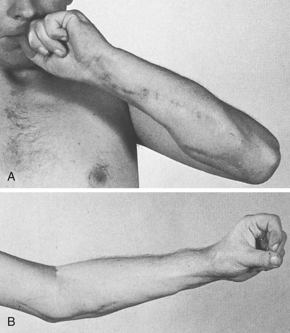 FIG 117.5, (A) A 21-year-old man sustained a brachial plexus injury in a motorcycle accident. Steindler's flexorplasty performed 16 months after injury restored excellent elbow flexion. Subsequent transfer of the flexor carpi ulnaris into the extensor carpi radialis brevis restored wrist extension, and finger and thumb extension were restored using the superficialis muscle of the middle and ring fingers. Shoulder arthrodesis was also performed. (B) Fixed flexion deformity of 35 degrees was present after Steindler's flexorplasty.