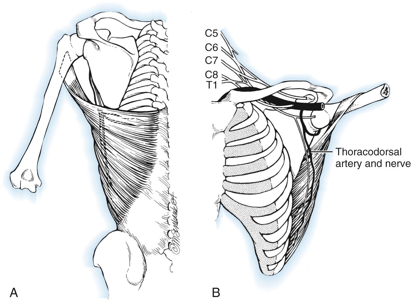 FIG 117.6, The anatomy of the latissimus dorsi. Shortly after entering the muscle, the single neurovascular pedicle (thoracodorsal nerve and artery) divides into lateral and medial branches.