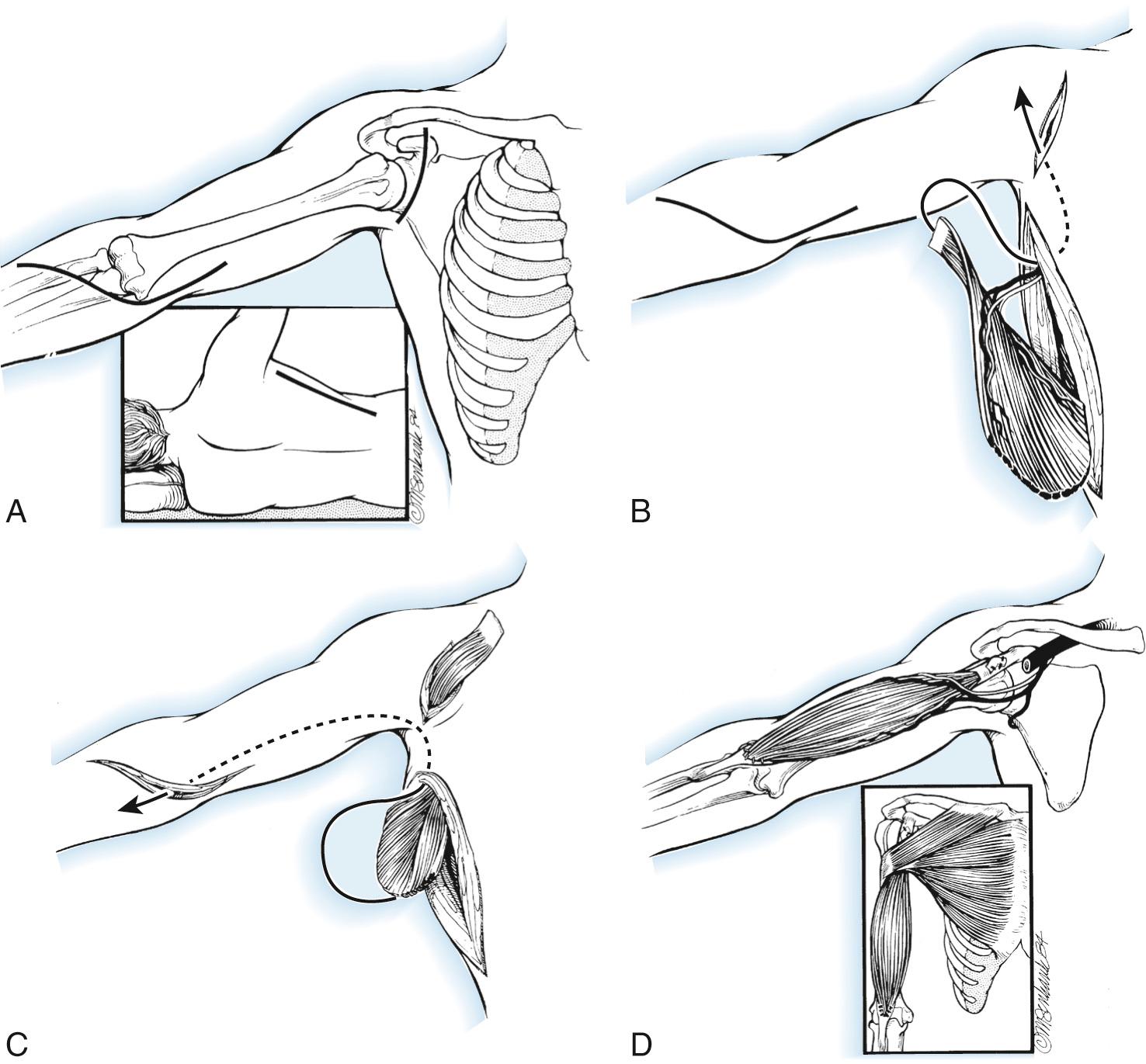 FIG 117.7, Bipolar transplantation of latissimus dorsi. (A) Incisions used for this procedure. (B) The origin and insertion of the latissimus dorsi are divided, and the muscle is mobilized on its neurovascular pedicle. (C) Transplantation of the muscle under a cutaneous bridge in the axilla; the origin is redirected through a subcutaneous tunnel in the arm to the biceps tendon. (D) The distal anastomosis is completed first, and the proximal attachment to the coracoid process and its conjoined tendon is used to set the tension.