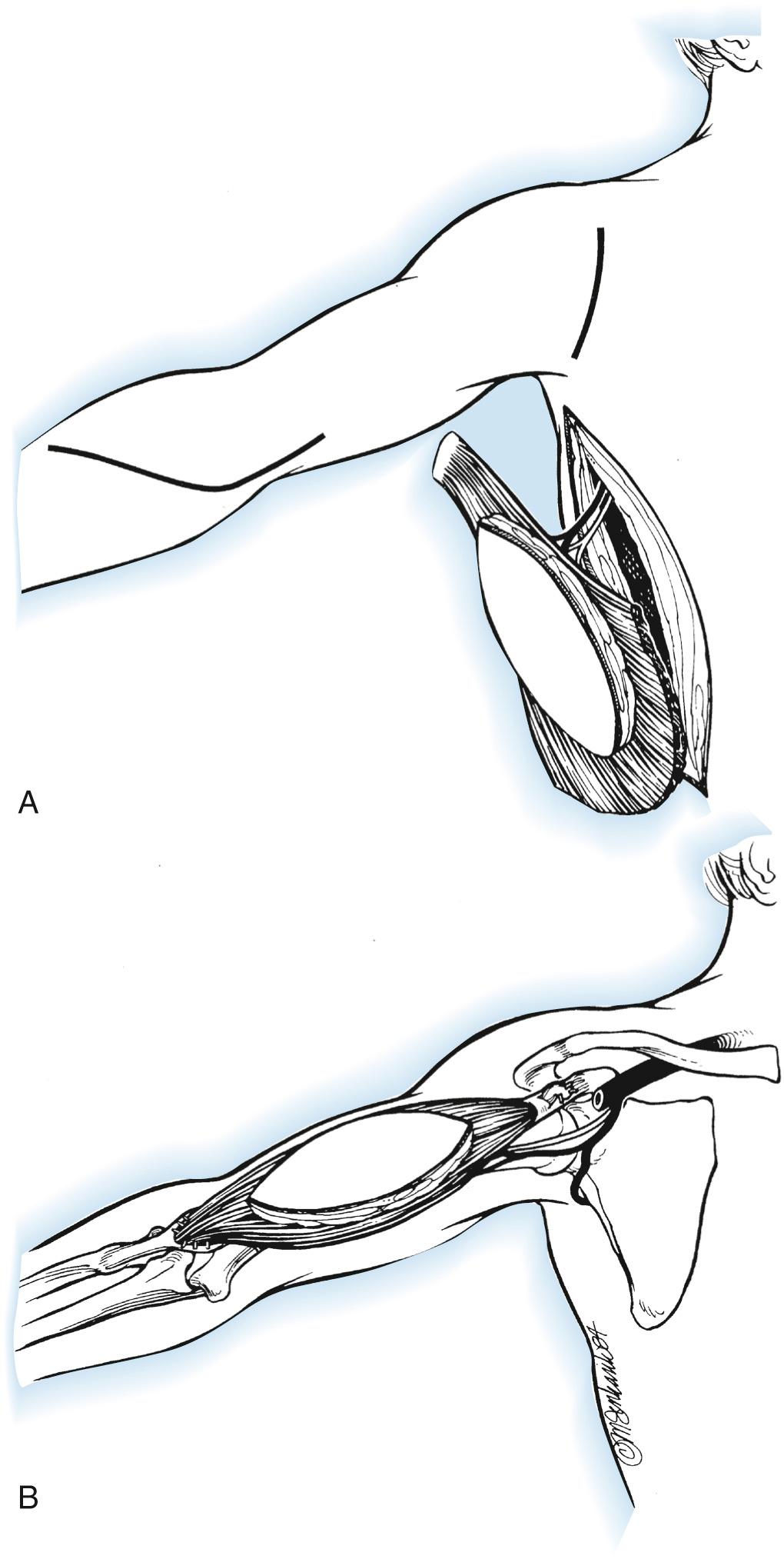 FIG 117.8, Technique used for myocutaneous latissimus dorsi transplantation. (A) Incisions used for this procedure. The origin and insertion of the latissimus doors are divided. The muscle is mobilized including a central skin island. (B) Transposition of the musculocutaneous flap on its neurovascular pedicle under a cutaneous bridge in the axilla; the origin is attached to the biceps tendon, and the insertion is attached to the coracoid process.