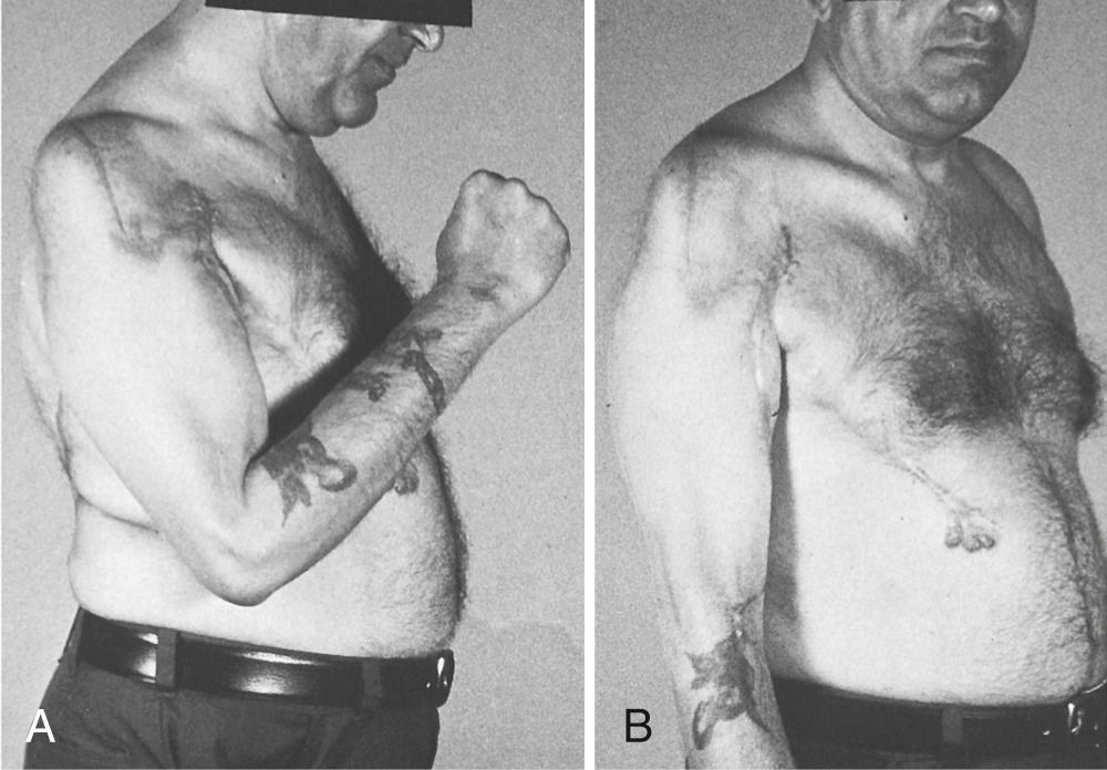 FIG 117.9, This 36-year-old man who had C5–C6 paralysis following a closed brachial plexus injury underwent a bipolar transfer of the latissimus dorsi 3 years after the injury. Good elbow flexion was restored (A), and nearly full extension of the elbow was maintained (B). Shoulder arthrodesis was also performed.