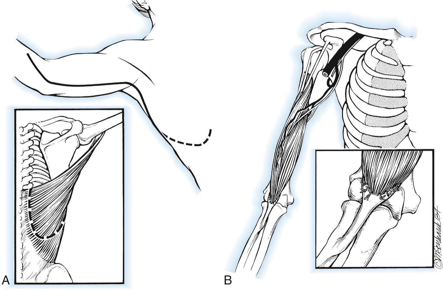 FIG 117.10, Unipolar transfer of the latissimus dorsi for elbow flexion. (A) Incisions employed. (B) The detached origin, rotated on its neurovascular pedicle, is attached to the biceps tendon and aponeurosis.